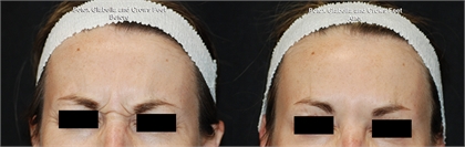 BOTOX and Dysport Before and After