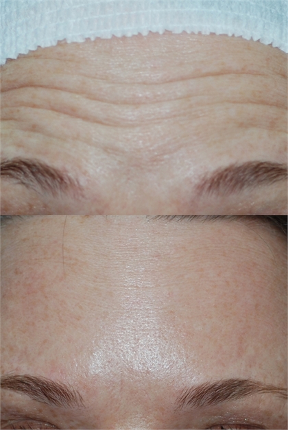 BOTOX and Dysport Before and After