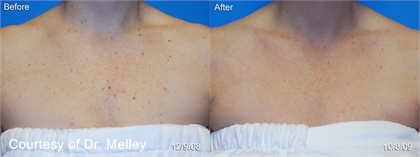 Cynosure Apogee Elite Laser Before and After