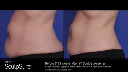 Body Contouring Before and After