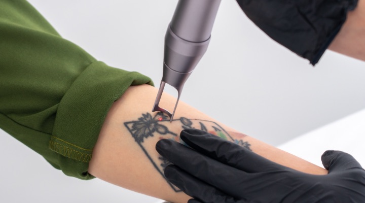 tattoo removal laser