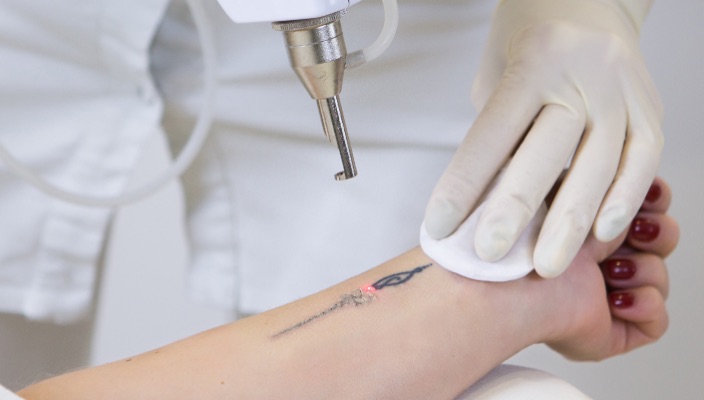 tattoo removal laser)