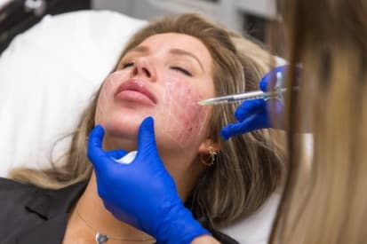 Pinehurst Laser — Restylane